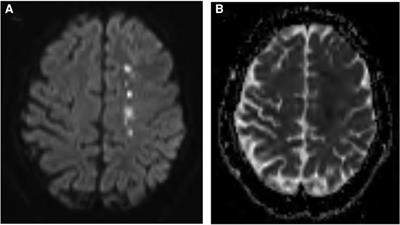 Case Report: A rare presentation of rapidly progressive moyamoya disease refractory to unilateral surgical revascularization